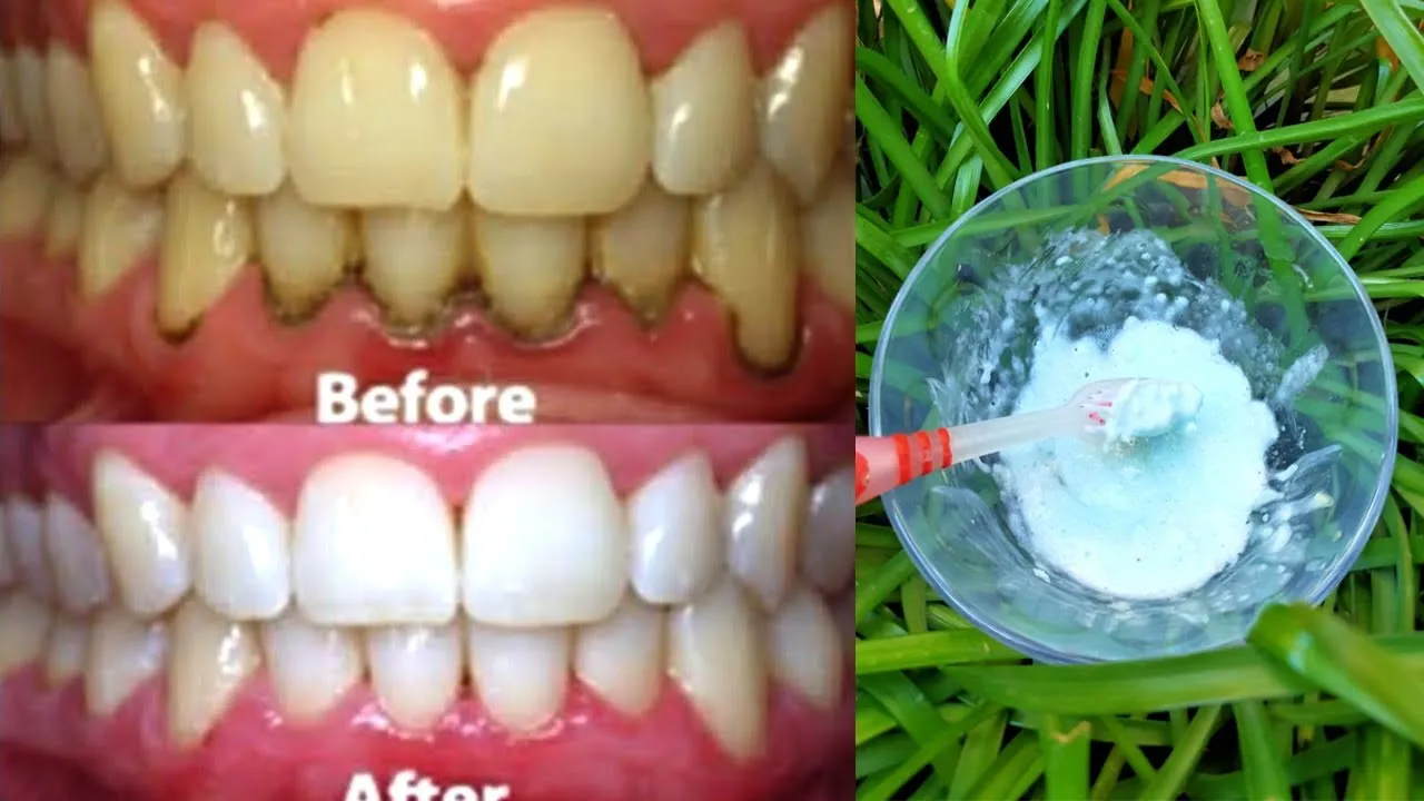 30431 teeth stains types