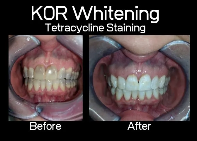 30432 kor whitening kits