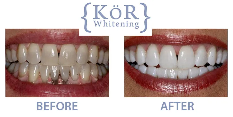 30432 professional teeth whitening