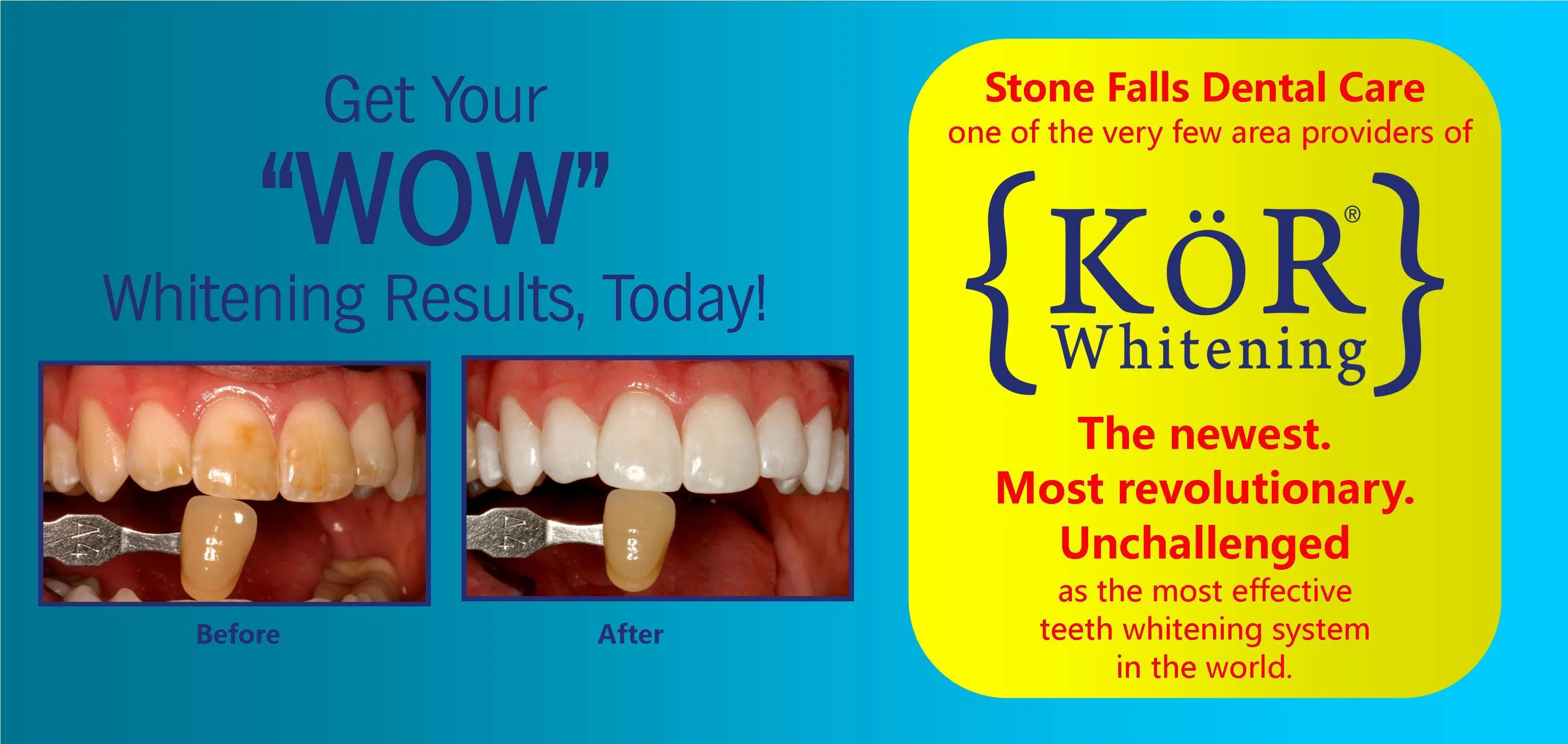 30432 teeth staining causes