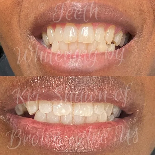 30434 at home teeth whitening