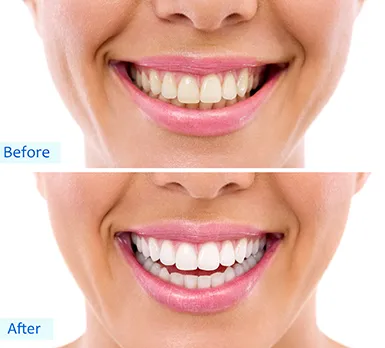 30434 professional teeth whitening