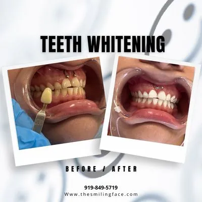 30434 teeth whitening aftercare