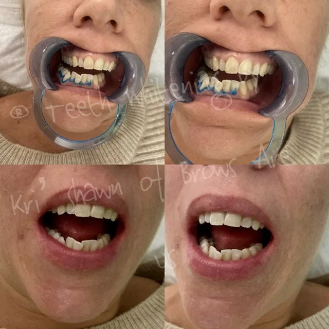 30434 teeth whitening results