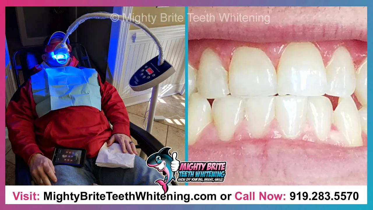30434 types of teeth whitening