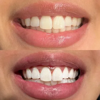 30444 professional teeth whitening