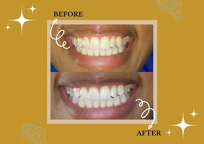 30446 bay area teeth whitening image4