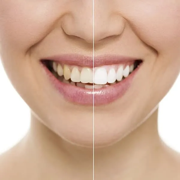 30453 professional teeth whitening
