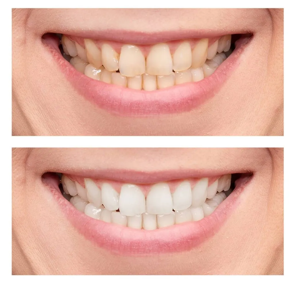 30459 teeth whitening confidence