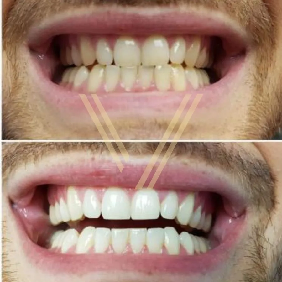 30459 turkey teeth whitening procedure