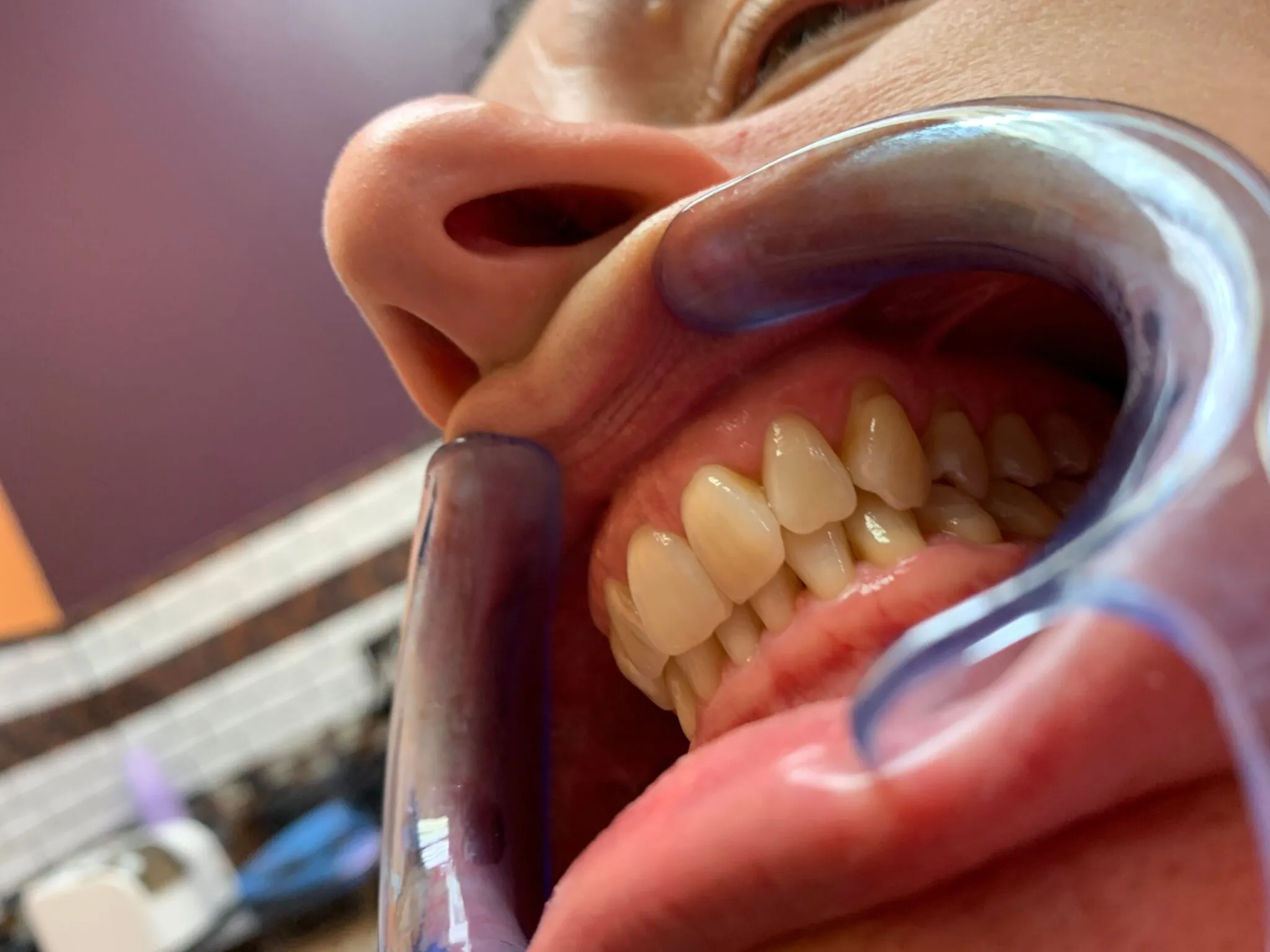 30460 teeth whitening joliet il aftercare