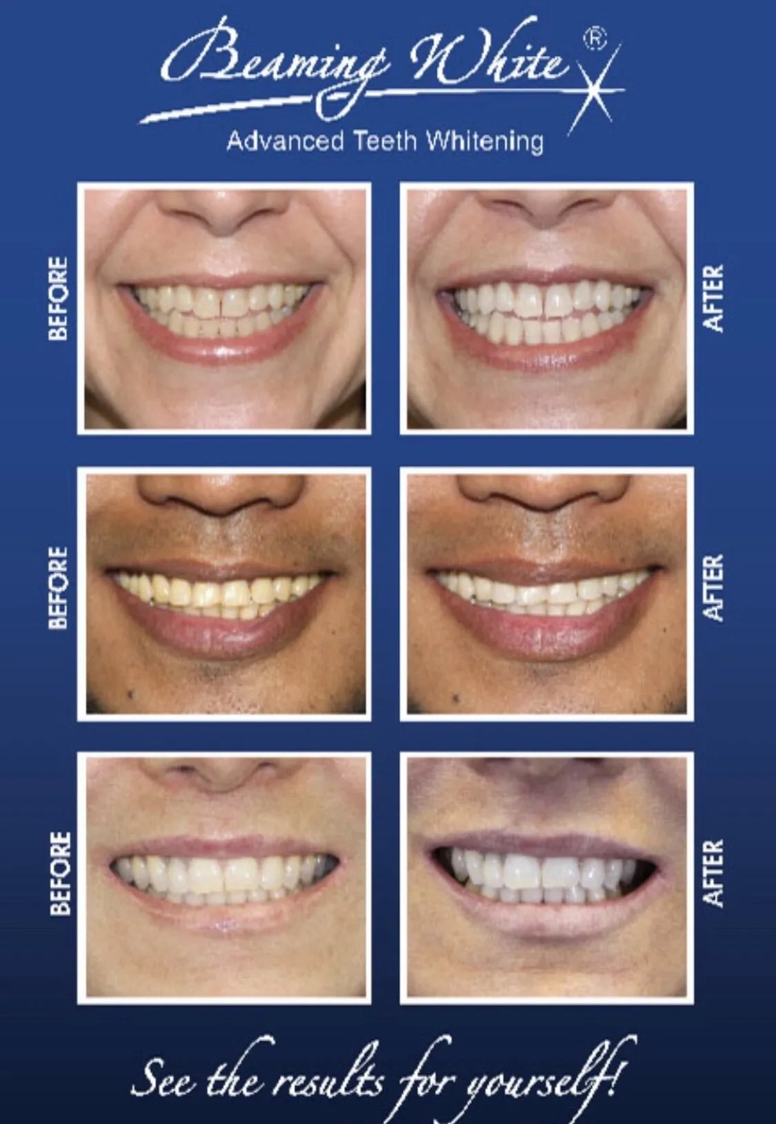 30460 teeth whitening joliet il in office