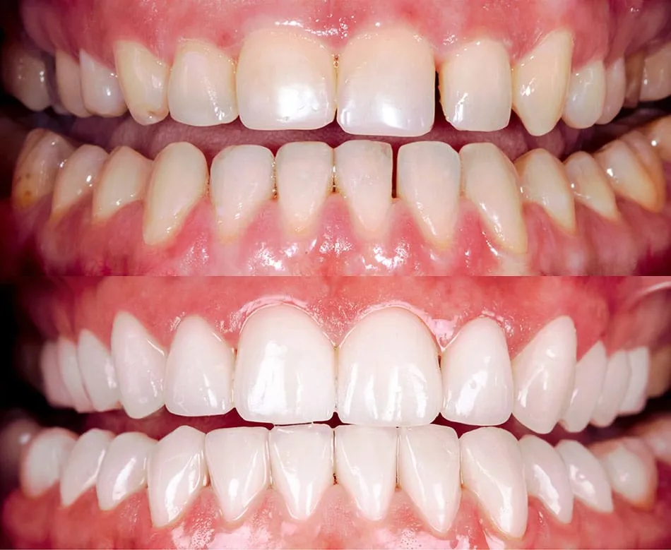 30462 albuquerque teeth whitening smiling