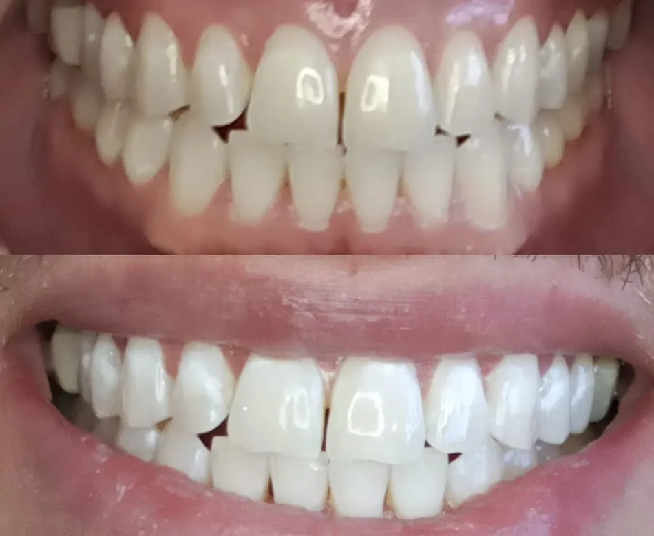 30462 at home teeth whitening kit