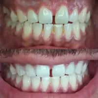 30462 teeth whitening before after