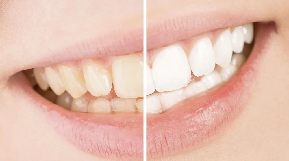 /img/30462-teeth-whitening-maintenance.webp