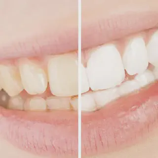 /img/30462-teeth-whitening-maintenance.webp