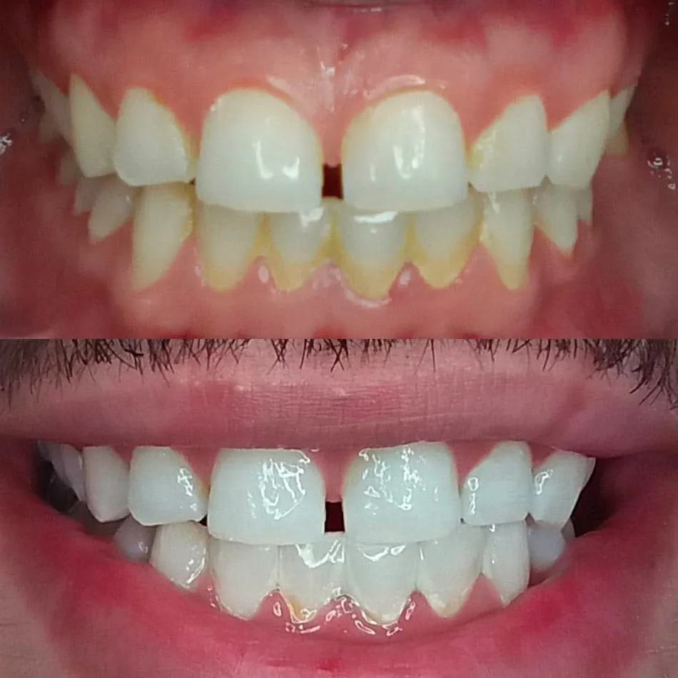30462 teeth whitening procedure