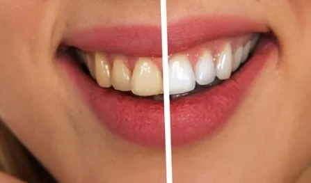 30463 baking soda teeth whitening