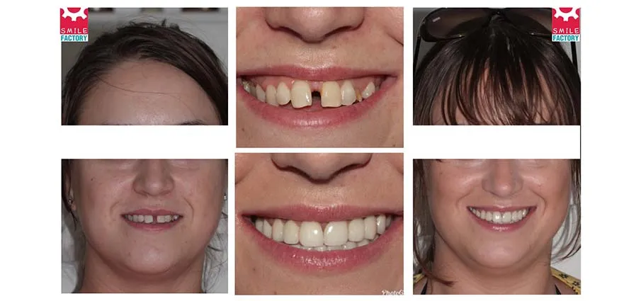 30464 smile factory teeth whitening at home kits