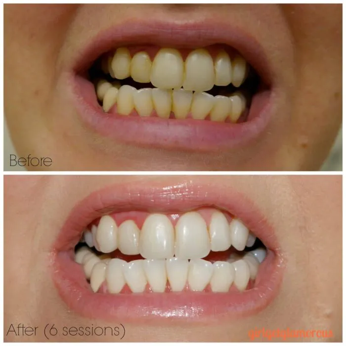 30464 smile factory teeth whitening healthy smile