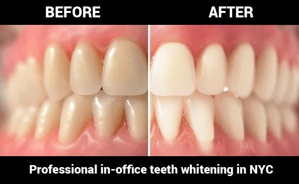 30465 teeth whitening options