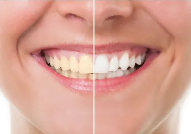 30465 teeth whitening procedure