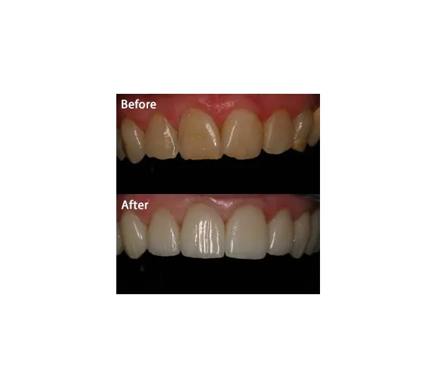 30468 take home whitening kit