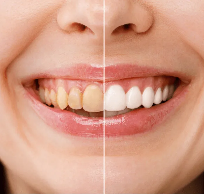 30468 teeth whitening procedure