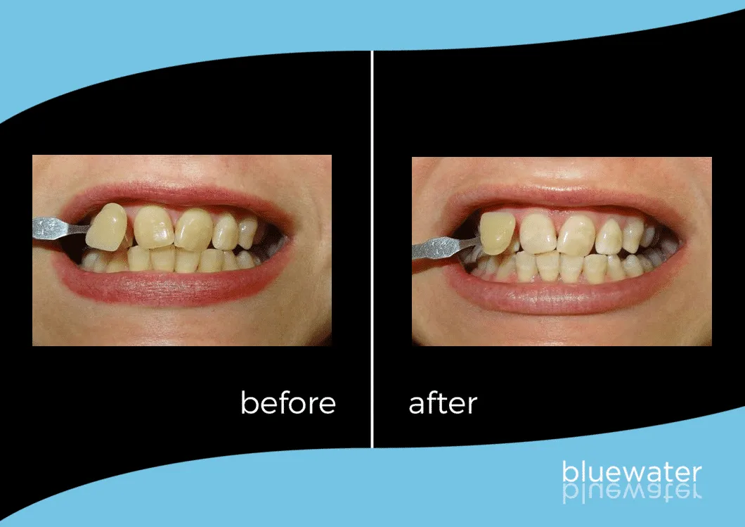 30470 zoom whitening results