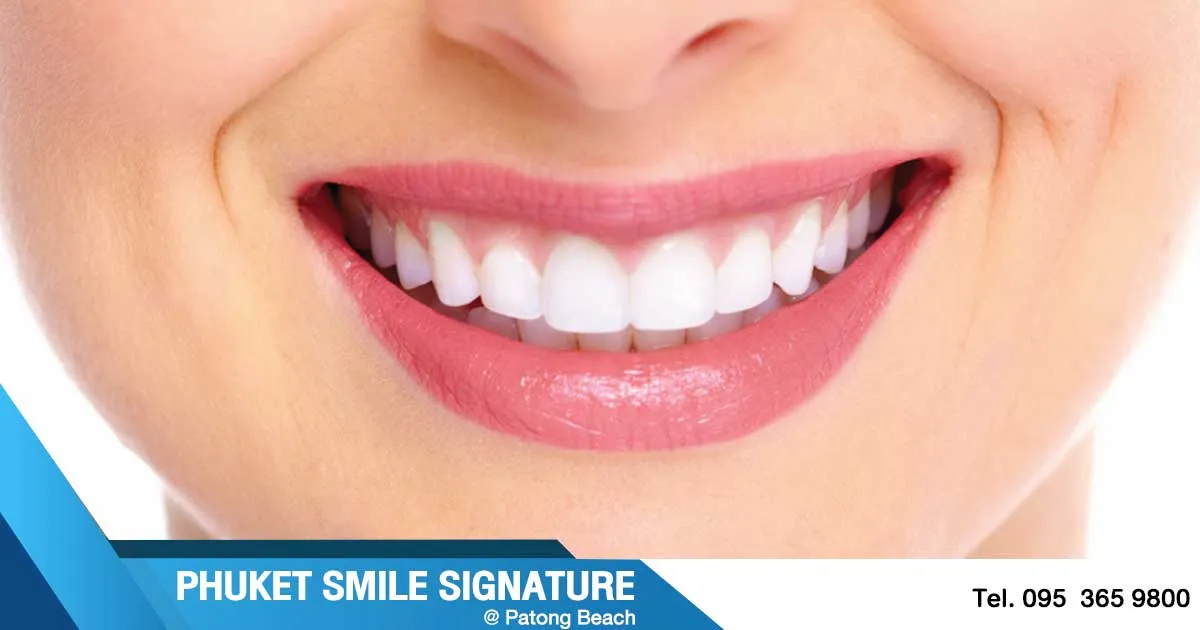 30472 at home teeth whitening kits