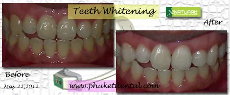 30472 in office teeth whitening