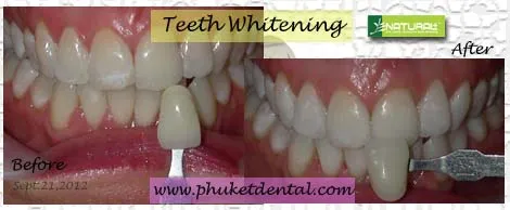/img/30472-teeth-whitening-aftercare.webp