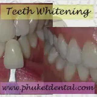 /img/30472-teeth-whitening-aftercare.webp