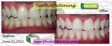 30472 teeth whitening before after