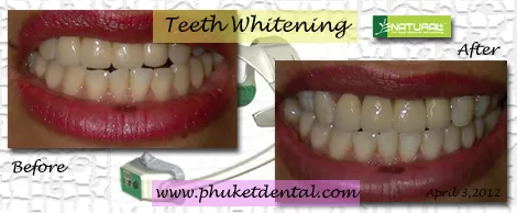 30472 teeth whitening phuket overview