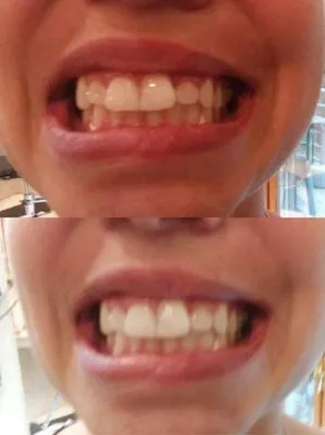 30476 teeth whitening ri dentist