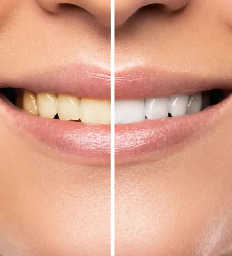 30476 teeth whitening ri home kit