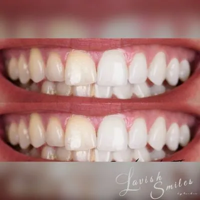 30476 teeth whitening ri natural remedies