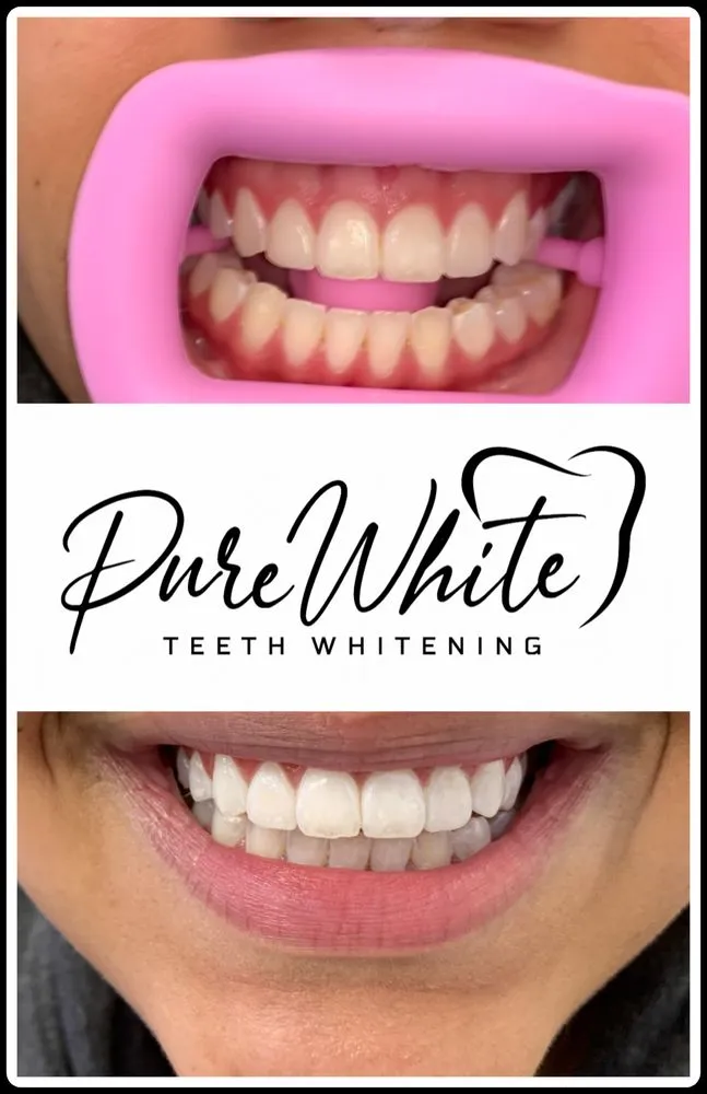 30476 teeth whitening ri professional