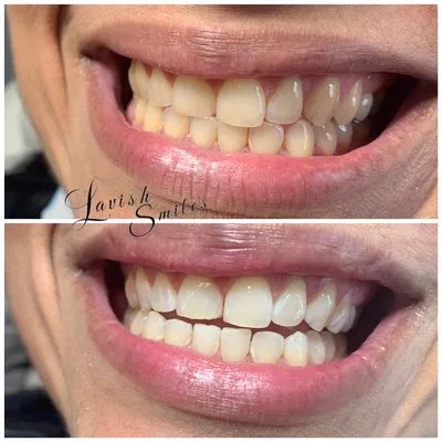 30476 teeth whitening ri toothpaste