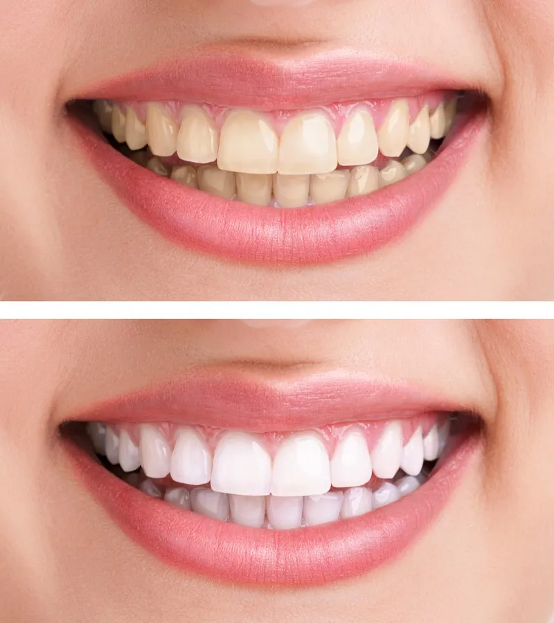 30482 teeth whitening columbia sc confident smile