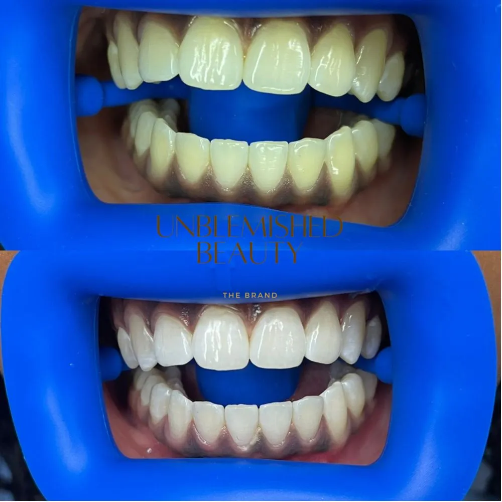 30482 teeth whitening columbia sc cost effectiveness