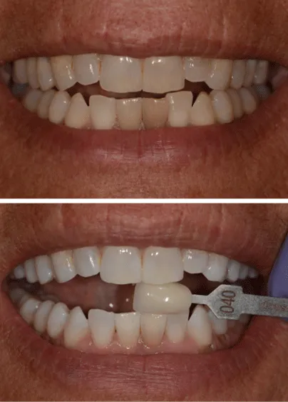 30482 teeth whitening columbia sc healthy smile