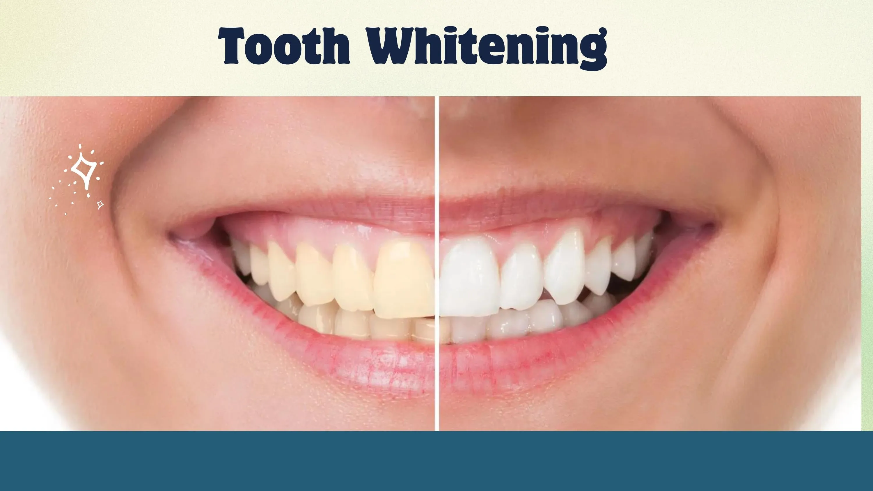 /img/30482-teeth-whitening-columbia-sc-in-office-vs-home.webp