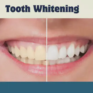 /img/30482-teeth-whitening-columbia-sc-in-office-vs-home.webp
