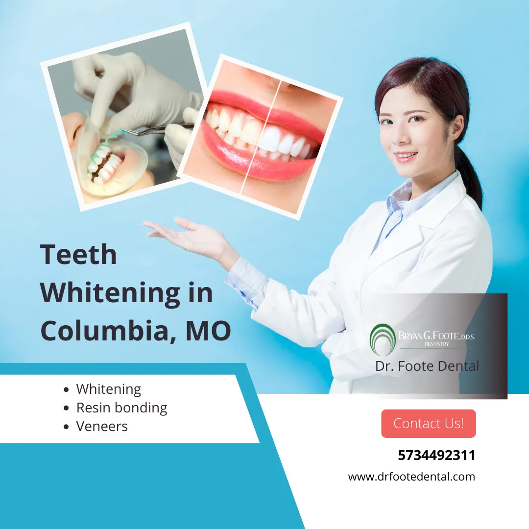 30482 teeth whitening columbia sc stain removal