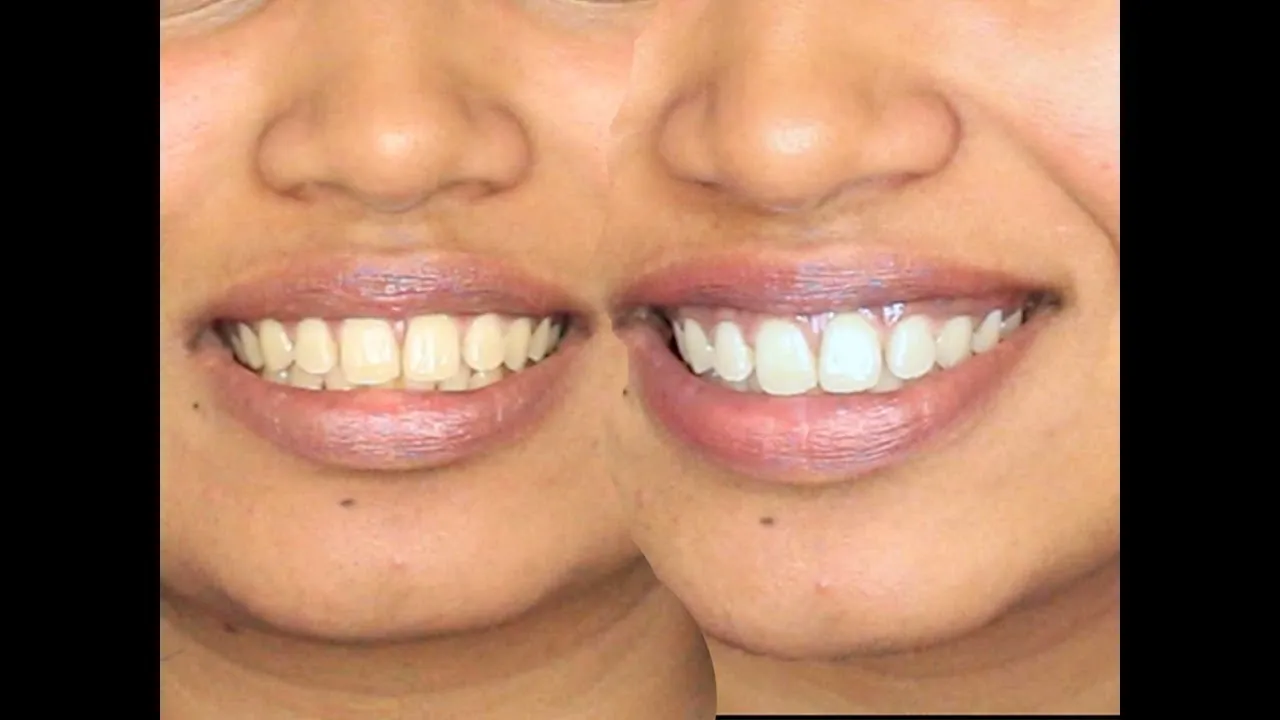 30488 coconut oil teeth
