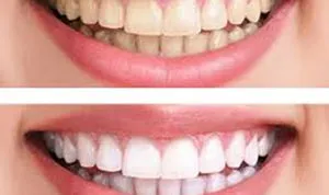 30490 teeth whitening process austin