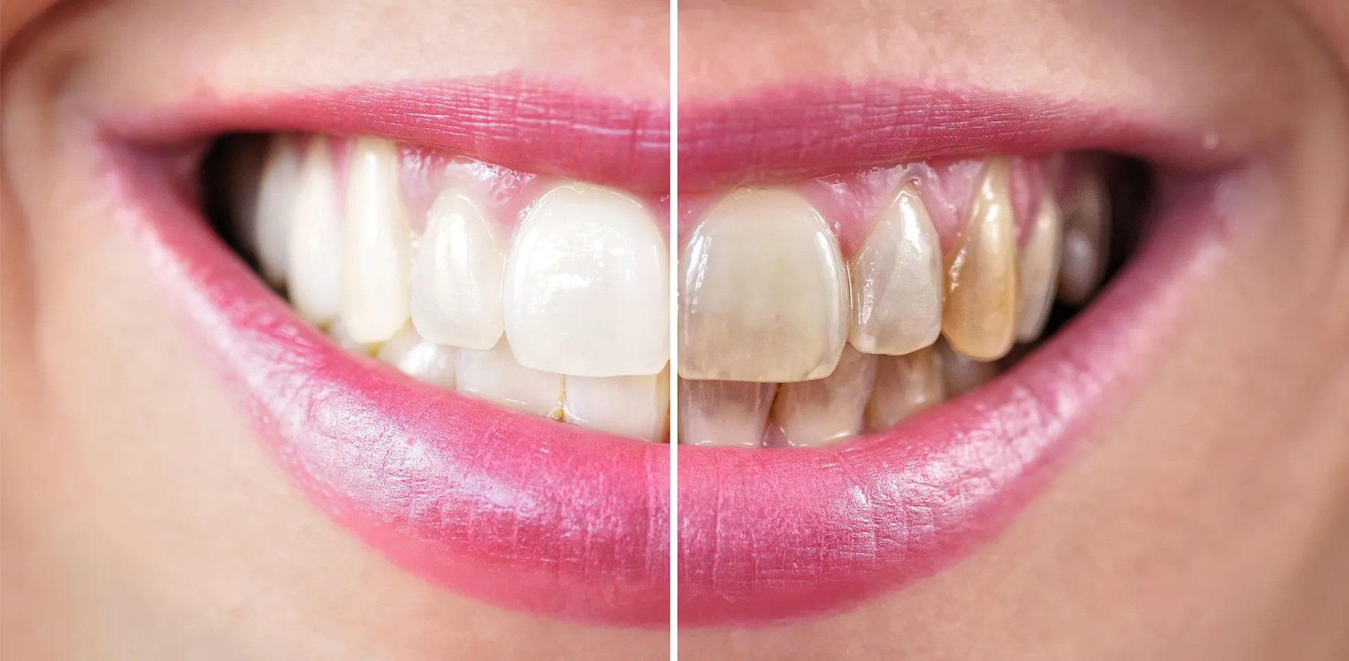 30492 whitening gums effectiveness